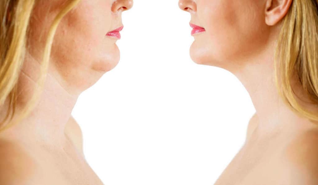 Double Chin treatment Brent Park before and after results