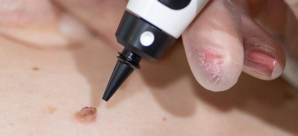 After Skin Tag Removal Brent Park