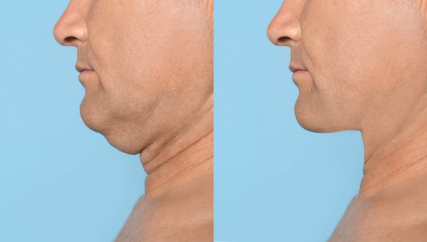Which Non-Surgical Treatments Work Best for Jowls and Loose Skin Brent Park?