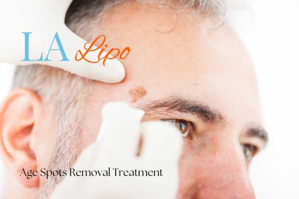 What Are the Most Effective Treatments for Age Spots Brent Park?