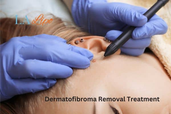 Dermatofibroma Removal Treatment Brent Park