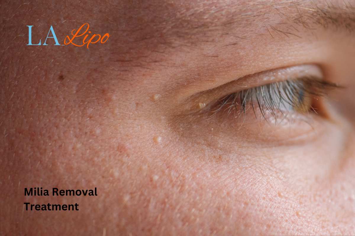 Cryopen Milia Removal: Is It the Easiest and Safest Option Brent Park?