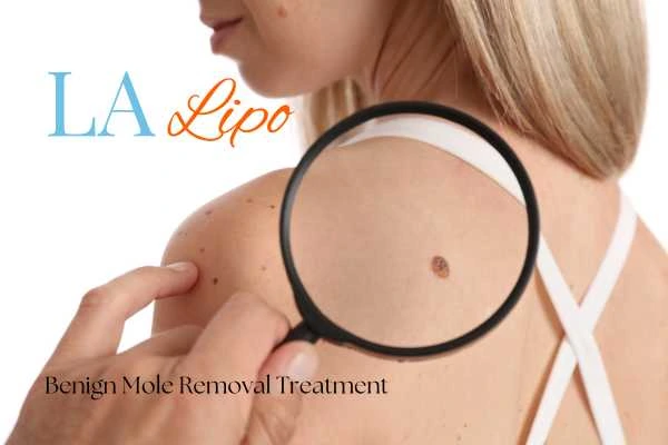 Why getting moles removed Brent Park can boost your confidence!