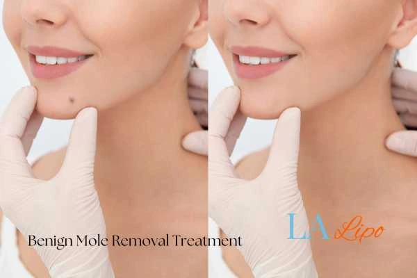 woman's before and after mole removal Brent Park results