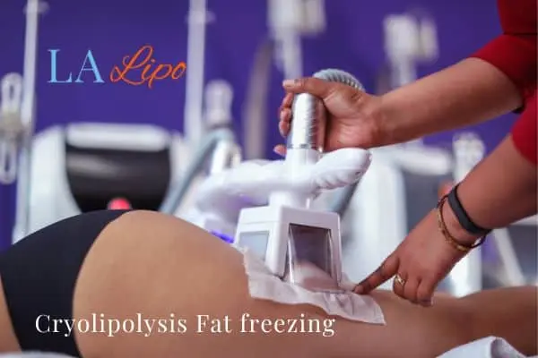 women getting fat freezing Brent Park