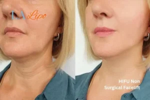 hi-fu for wrinkles Brent Park before and after results