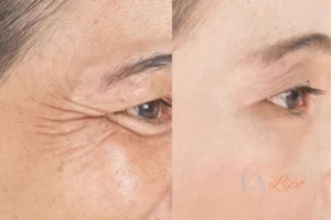 Before and after results of woman - HI-fu wrinkles reduction treatment Brent Park