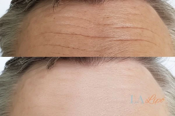 results of HIFU Brent Park on mans forehead to help reduce lines and wrinkles