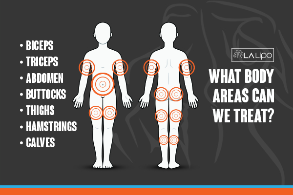 Graphic to show areas you can have LA-EMS Body Sculpting Brent Park treatment.