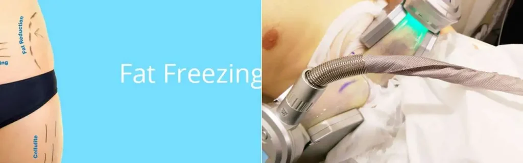 multi areas of a persons body having coolsculpting Brent Park treatment