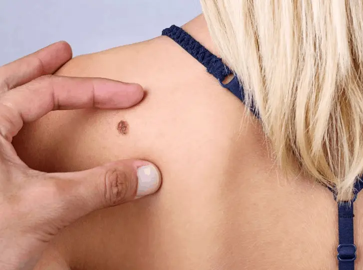 woman having mole removal Brent Park consultation before treatment.