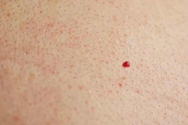 close up of a cherry angioma Brent Park