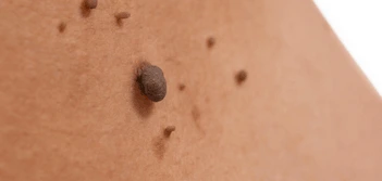 image of a skin tag Brent Park