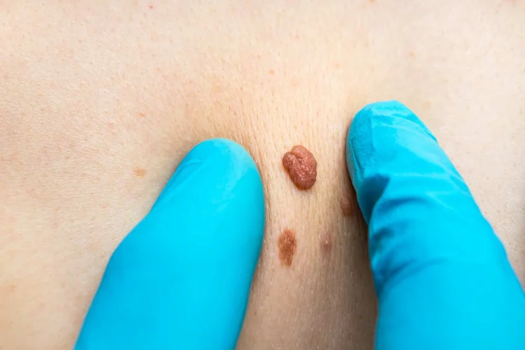 Consultant examining a skin tag Brent Park