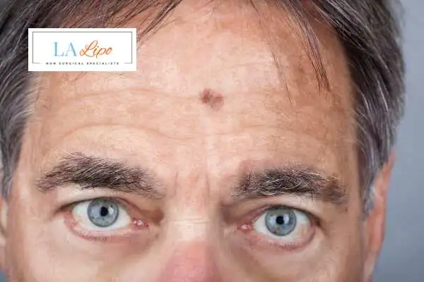 Solar Lentigo Removal Brent Park image of man with mark on his forehead