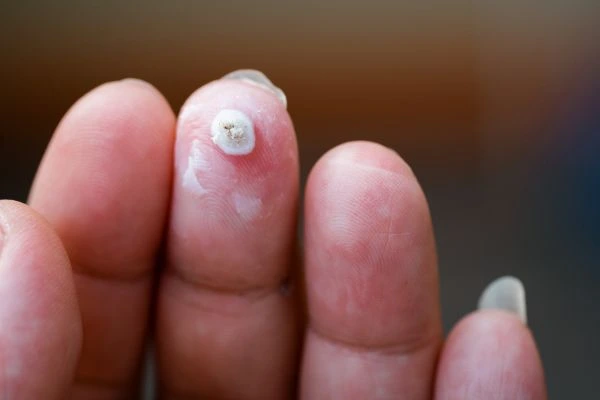 wart on person finger - cryotherapy to treat from LA LIPO Brent Park