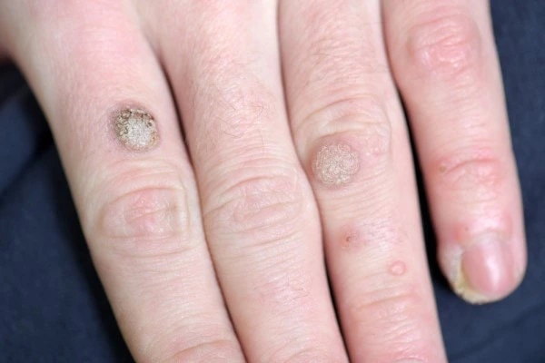 photo of warts on person hand - see wart removal Brent Park from LA LIPO