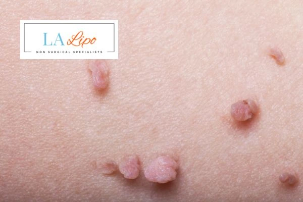 Does cryopen skin tag removal Brent Park hurt? Find out now call our team today!