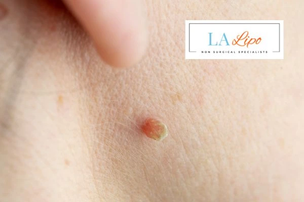 Book skin tag removal Brent Park today speak to our team now!