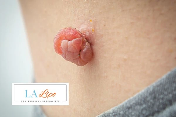 Interested in skin tag removal Brent Park? Concerned about the pain? Find out more today!