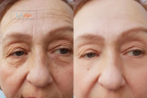 The powerful benefits of Morpheus8 Treatment Brent Park - Call Our team today!
