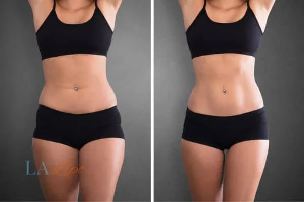 before and after results of non-surgical treatment to help a woman's body image and mental health Brent Park