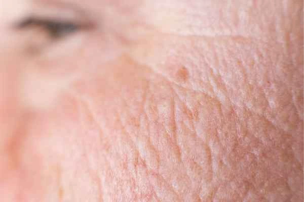 close up picture of a woman's face showing an age spot Brent Park
