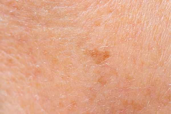 close up picture of age spots Brent Park