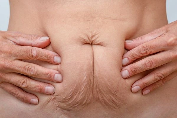 Should I Combine Diastasis Recti Treatment with Body Contouring for Better Results Brent Park?