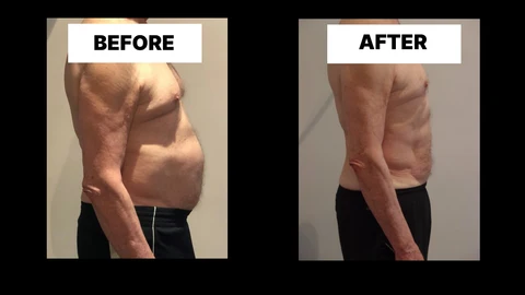 What Symptoms Can Diastasis Recti Cause in Men? Weak Core, Back Pain and Poor Posture Brent Park